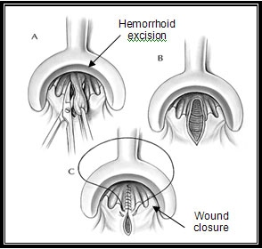 Hemorrhoidectomy | UCSF Robotic Surgery