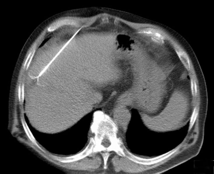 rfa tumor - CCC license